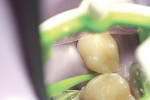 Figure 11  Infiltration of the mesial aspect of tooth S.
