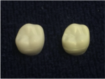 Fig 1. An example of discolored teeth.