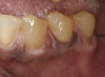 Fig 1. A preoperative view of the mandibular left canine and first premolar in a 61-year-old female patient.