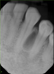 Fig 2. A large tear-drop radiolucency located between the roots of the left canine and first premolar.