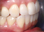 Figure 3  Preoperative right lateral retracted view of the patient’s teeth, revealing similar discoloration on this side.