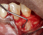 Fig 5. Perforation of the thin buccal bony plate due to the large cyst.