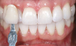 Figure 4  Using the classic Vita shade tab, the patient’s pre-bleaching shade was determined to be A1.