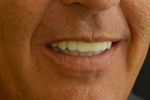 Fig 12. Post-treatment smile at 1-year follow-up.