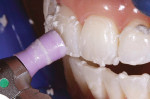 Figure 6  Before the bleaching procedure, the teeth were carefully cleaned with pumice to remove extrinsic stains.