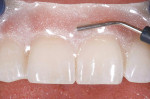 Figure 7  The unique OpalDam® gingival protector was expressed in a thick strip onto the gingiva.
