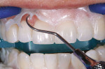 Figure 12  The gingival barrier (OpalDam) was lifted off and removed using an explorer.
