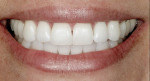 Figure 17  Final postwhitening treatment view of the patient’s natural smile.
