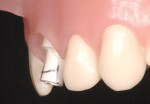 Figure 7  A lateral view demonstrates the need for twoplane reduction of the buccal surface of the temporary abutment similar to that of a crown preparation.
