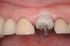 Fig 4 . Virtual design of maxillary (Fig 4) and mandibular (Fig 5) provisional restorations, transparent view.