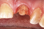 Figure 1  Traumatic fracture of a previously endodontically treated maxillary left central incisor. Note the fracture is near the gingival free margin.