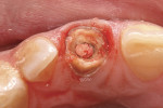 Figure 2  Traumatic fracture of a previously endodontically treated maxillary left central incisor. Note the fracture is near the gingival free margin.