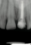 Figure 3  Radiograph of fractured incisor demonstrating the enlarged root canal after the completed root canal therapy. It is evident that the compromise in biologic width will require crown lengthening.