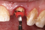 Figure 5  The Rebilda Post canal reamer with endodontic stopper verified the length needed for fiber post placement.