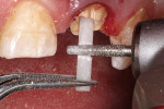 Figure 6  The Rebilda Fiber Post was fitted to the root canal, stabilized with cotton pliers, and cut to the length needed using a diamond on a highspeed handpiece with water spray.