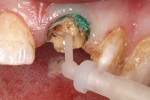 Figure 9  An automixed, dual-cured composite resin core restorative was syringed into the root canal for post cementation.