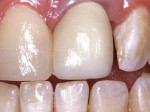 Figure 13  The completed all-ceramic crown and direct composite bonding of the adjacent central incisor.