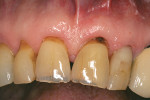 Figure 1  This 84-year-old man presented with caries in the root surface of tooth No. 9, a restoration on tooth No. 10, and recession on other anterior teeth, putting them at risk for decay.