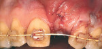 Figure 6  The SECT graft was placed on the mesial and facial surfaces of tooth No. 10, stabilized with sutures, and partially covered with the facial flap.
