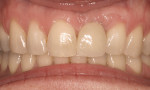 Figure 7  Two years after the restoration was completed, the tissue color and contour match the adjacent teeth. (Restoration by Dr. Michael Vitale, Bronxville, NY.)