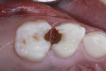 Class II caries lesions of primary molars in a 5-year-old.