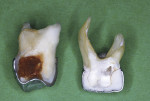 Simulated Hall crown on sectioned carious primary molar (left). Sectioned extracted primary molar 7 years after traditional stainless steel crown restoration (right).