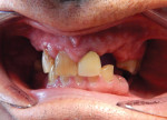The patient presented with a severely broken
down dentition as well as significant bite
collapse, with a chief complaint of fractured
teeth to the point that his existing maxillary
partial would not stay in place and it was
extremely difficult to eat.