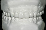 Figure 4  Approximately 80% of the entire case is completed before tooth preparation.