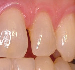 Figure 1  Undersized maxillary lateral incisor with mesial diastema.