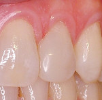 Figure 2  Mesial diastema closed using N’Durance composite resin with a totaletch adhesive resin technique