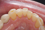 Figure 3  Wear into the dentin of mandibular anterior teeth, incisal view.