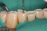 Figure 5  Intradentin preparation of mandibular anterior incisal edges to a depth of 1 mm, leaving the enamel intact for bonding and restoration.