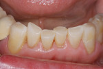 Figure 6  Incisal wear restored with N’Durance.