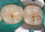 Figure 7  Occlusal caries on the first and second mandibular molars.