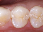 Figure 10  Interproximal caries is evident on the radiograph, with no occlusal caries on the maxillary first premolar.