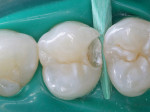 Figure 11  Conservative, minimally invasive slot preparation on the distal surface.