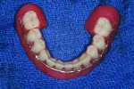Fig. 9 An upper immediate denture is delivered at the first surgical appointment and a lower immediate denture is converted to an implant-supported prosthesis.