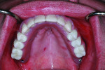 Fig. 26 The successful restorations are shown in the patient’s mouth on recall visits.