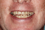 Fig 6. Uneven smile line of both upper and lower dentitions during unrestricted smile.