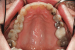 Fig 3. Numerous biomechanically compromised teeth in the upper arch.