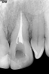 Figure 2  The completed endodontic treatment.