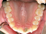 Figure 4  The occlusal view during internal bleaching