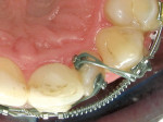 Figure 7  Buttons and chains on the lateral incisor for reciprocal force.