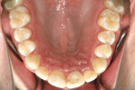 Figure 10  The maxillary arch view, after orthodontic treatment.