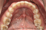 Figure 11  The mandibular arch view, after orthodontic treatment.