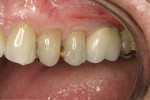 Figure 1  Buccal preoperative view of tooth No. 13.