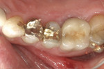 Figure 2  Occlusal view of fractured cusp.