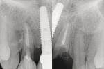 Fig 2. Periapical radiographs before treatment.
