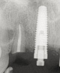 Fig 6. Submerged root after endodontic re-treatment.