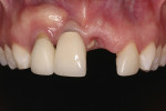 Fig 1. Initial intraoral view of the partially edentulous dentition.